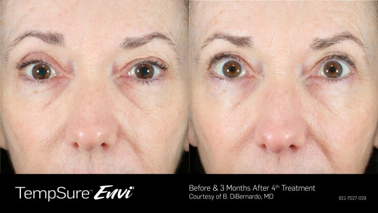 TempSure Envi Before & After | Skin Tightening