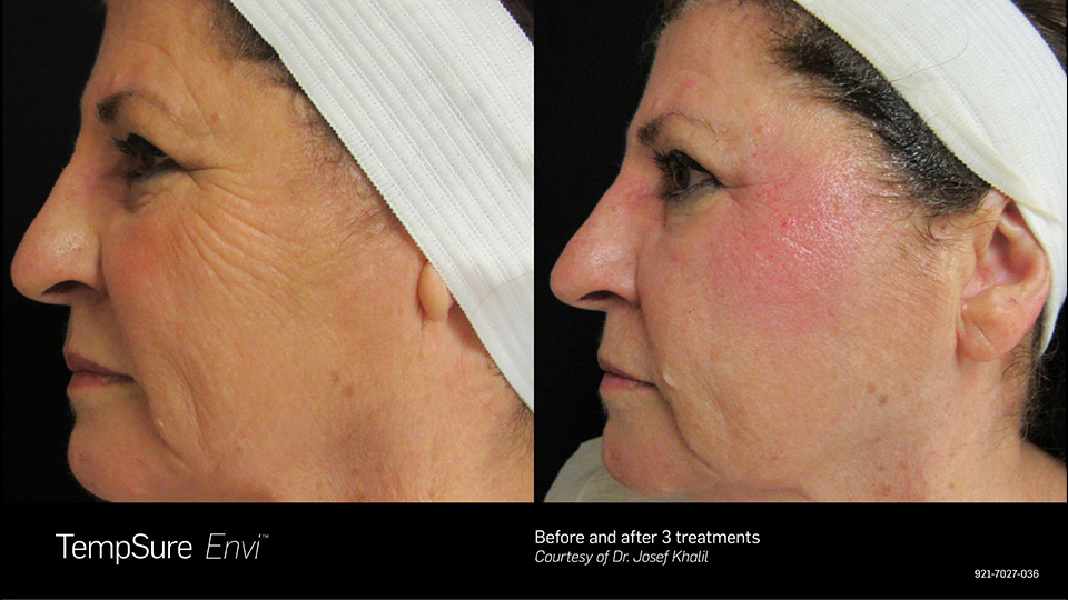 TempSure Envi Before & After | Skin Tightening