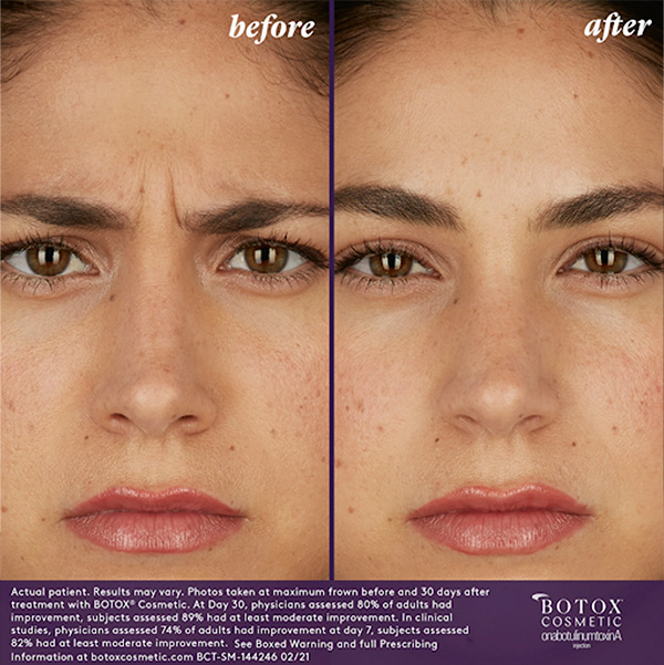 BOTOX Before & After | BOTOX & Fillers