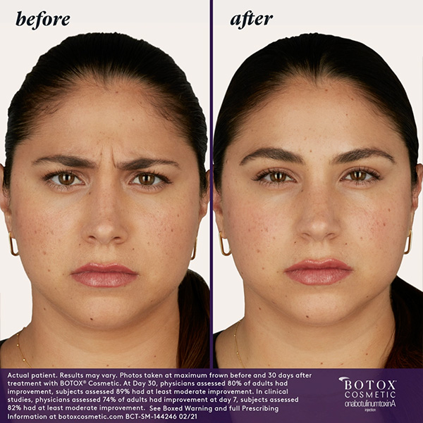 BOTOX Before & After | BOTOX & Fillers